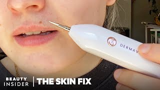 Heated Needle Tool Claims To Remove Skin Tags And Moles At Home  The Skin Fix  Beauty Insider [upl. by Hali499]