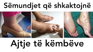 AJTJA E KEMBEVE  Cilat semundje shkaktojne ajtje  TROMBOZA veins semundje ajtja kembet edema [upl. by Ama]