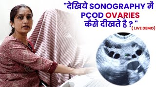 देखिये Sonography में PCOD Ovaries कैसे दीखते है  Dr Asha Gavade [upl. by Reina]