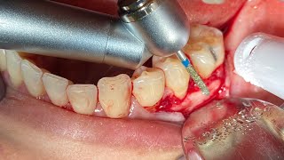 OSSEOUS SURGERY AT LOWER MOLAR [upl. by Langille219]