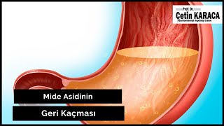 Mide Asidinin Geri Kaçması  Mide Asidi Nedir  Mide Asidi  ProfDrÇetin Karaca [upl. by Burrell]