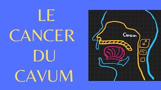 CANCER DU CAVUM LESSENTIEL PARTIE 6 [upl. by Amand819]