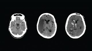 How to Read a CT Scan of the Head  MEDZCOOL [upl. by Guillema565]