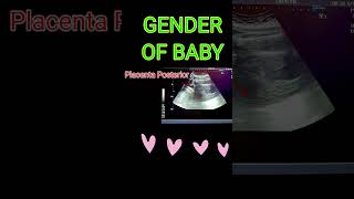 BABY GENDER VS PLACENTA shortsfeedpregnancy [upl. by Anam204]