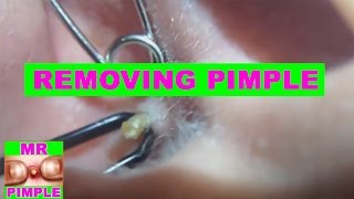 Removing Pimple Inside The Ear  Mr Pimple [upl. by Amik]