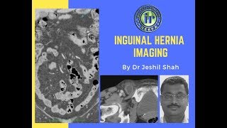 TMT Inguinal Hernia Imaging by Dr Jeshil Shah [upl. by Arodasi]