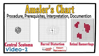 Amslers Chart Procedure Prerequisites Scotoma Interpretation Documention Video2 [upl. by Kaule]