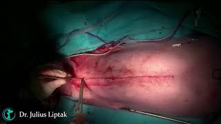 Thymoma Resection via Median Sternotomy 20241008 [upl. by Soisatsana]