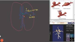 Subarachnoid Hemorrhage [upl. by Anissej]