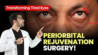 देखिए Under Eye Bags Gone Best Treatment For Puffy Eyes Blepharoplasty  Dark Circles  Pune DrDC [upl. by Araihc75]