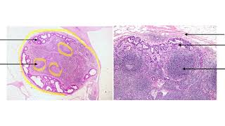 ADENOCARCINOMA METASTASIS TO LYMPH NODE [upl. by Eixirt]