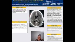 Leptomeningeal Carcinomatosis BRCAmutation related triple negative breast cancer [upl. by Roberto]