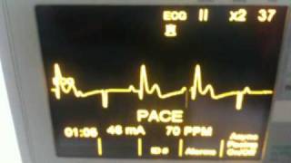 3rd Degree Heart Block Paced at 70 PPM [upl. by Stallworth]