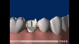 Universal adhesive Futurabond UPart 1212 Luting of root posts with a DCCC luting composite [upl. by Kurys]