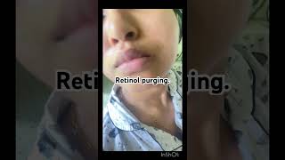 Retinol purging shorts youtubeshorts trendysong retinol skincare purging skincaretips acne [upl. by Sadella208]