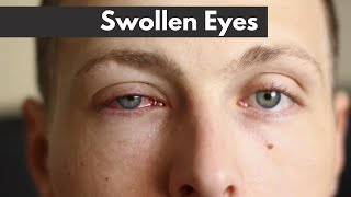 Swollen eyes  EXPLAINED  Dr DOrio Eyecare [upl. by Atinra571]