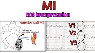 Myocardial infraction on ECG leadsAnterior wall MIinferior wall MIlateral wall MIPosterior MI [upl. by Reel]