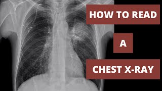 A Radiologists Approach to Reading CXR  Radiology 101 [upl. by Acnayb701]