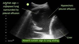 Lung ultrasound  Simple pleural effusion VS hydropneumothorax [upl. by Aihsenod]