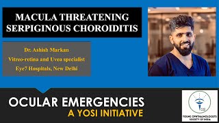 Macula Threatening Serpiginous Choroiditis  Dr Ashish Markan  YOSI Ocular Emergency  Episode 19 [upl. by Wellington]