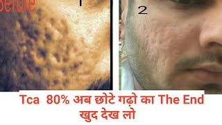 Tca Cross For acne scars । part3 [upl. by Notsehc]