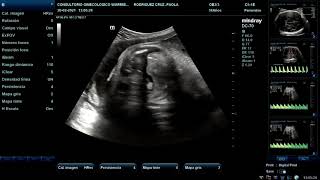 Ecografía Doppler Fetal [upl. by Eatnahs]