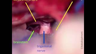 Trigeminal Neuralgia [upl. by Eirehs]