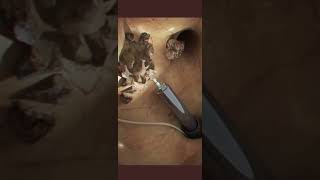 Kidney Stone Surgery Using Laser [upl. by Oravla]