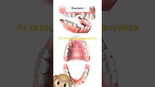 Extractions in orthodontics orthodontictips ортодонтия kieferorthopädie ortodonzia orthodontie [upl. by Tracee165]