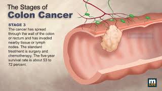 Stages of Colon Cancer [upl. by Akins]