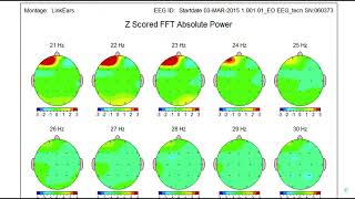 Estudio de encefalograma sobre los beneficios de las barras de access [upl. by Eelam]
