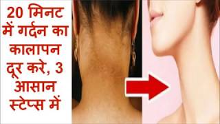 How to Get Rid of Dark Neck in 20 Minutes  Black Neck  Hyperpigmentation [upl. by Deragon]