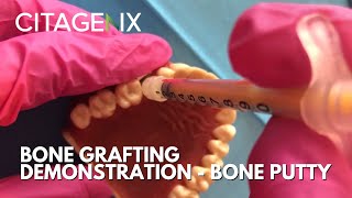 Basic Bone Grafting Procedure Demonstration Using Citagenix Products  Citagenix [upl. by Lattie367]