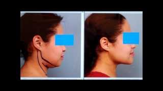 Sculpt the Chin amp Neck With Liposuction  Dr Sterry Explains [upl. by Cynar]