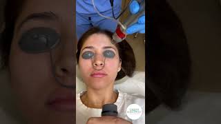 Erbium Laser easy and fast treatment [upl. by Eecats]