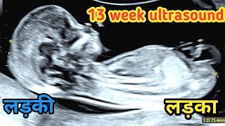 ✨13 weeks baby on ultrasound 👶🏻💓🤰🏻pregnancy baby anatomy heart pregnancy pregnant baby [upl. by Zins]