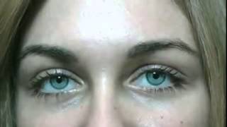 Bright Ocular surgery to change your eye color permanently to ice gray [upl. by Picker]