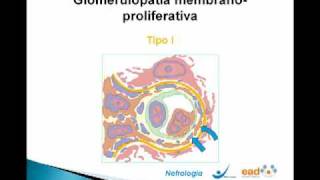 Glomerulopatias Primárias II  Parte 1 [upl. by Laehcim]