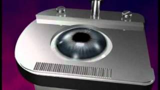 3D Lasik Eye Surgery Animation [upl. by Lentha]