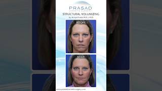 Comparing Structural Volumizing to a Stem Cell quotFaceliftquot nonsurgicalfacelift [upl. by Lounge]