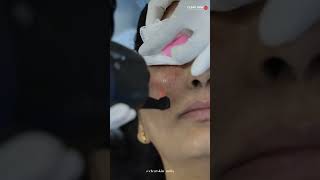 CO2 Laser Treatment  Clear Skin Pune [upl. by Ahseenyt]