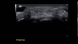 Normal Wrist Extensor Axial Video JETem 2019 [upl. by Esilehs]