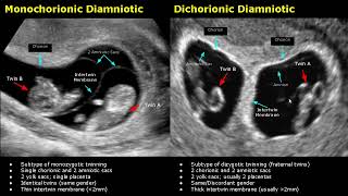 Fetal Twins Ultrasound Normal Vs Abnormal  MonochorionicDichorionicDiamnioticMonoamniotic USG [upl. by Eniarda]