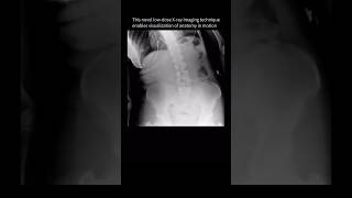 Spine movement seen for the FIRSTTIME with dynamic XRay backpain anatomy [upl. by Atteiram]