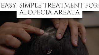 Treatment for Alopecia Areata hairlosstreatment [upl. by Ellebasi]