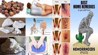 Treatment for Piles  Khooni aur Badi Bawaseer Ka ilaj  Bawasir ka Desi ilaj Home Remedy for Piles [upl. by Ahseuqram]