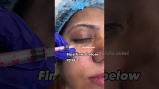 Fine lines gone in 7 days babybotox mesobotox botox botoxinjections wrinkles antiageing [upl. by Ysor]