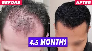 MOST INSANE Finasteride Hair Regrowth You Will See 4 Month Result [upl. by Wallie]