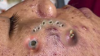 Big Cystic Acne Blackheads Extraction Blackheads amp Milia Whiteheads Removal Pimple Popping 090 [upl. by Aillil]