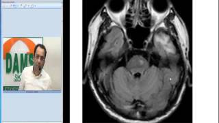 Radiology Spotters by Dr Sumer Sethi 34  Wallerian Degeneration [upl. by Harned]